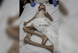شهيد جديد بسبب المجاعة في غزة