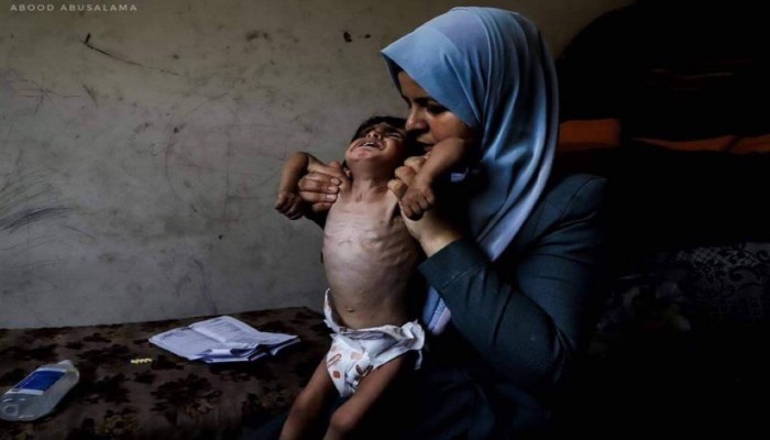 استشهاد الطفل الـ 40 بسبب المجاعة في قطاع غزة