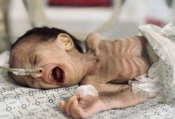 سياسة الاحتلال لتجويع غزة تقتل 4 أطفال بمستشفى كمال عدوان خلال أسبوع