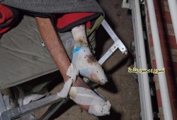أطباء بلا حدود تؤكد حاجة 12 ألف جريح في غزة للعلاج بالخارج