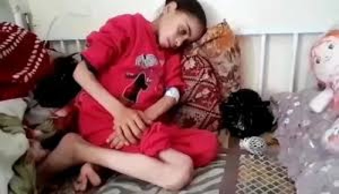 غزة في المجاعة الكاملة.. الجسد الهزيل يضعف عن صيحة الاستغاثة