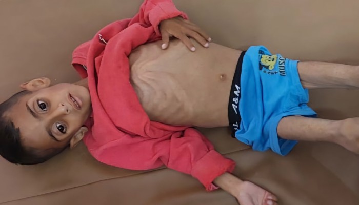 وفاة 66 طفلا نتيجة سوء التغذية بغزة