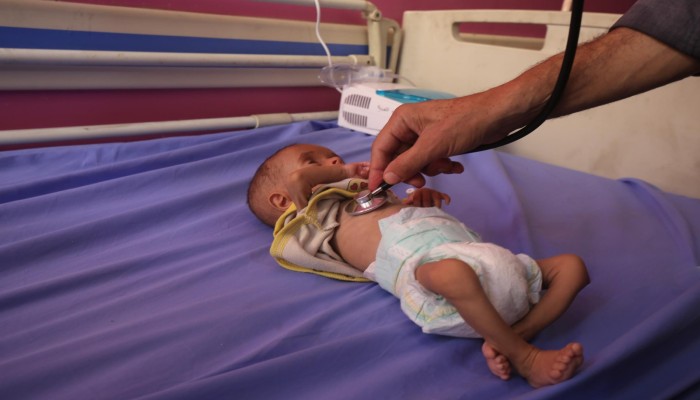 استشهاد طفلة جوعا في غزة