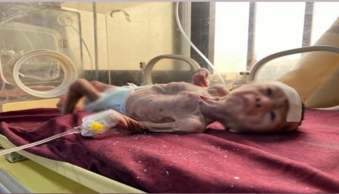 استشهاد  5 فلسطينيين جوعًا في غزة خلال 24 ساعة