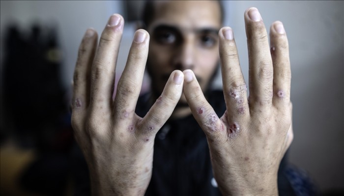 سجون الاحتلال تتعمد نقل العدوى للأسرى وتتجاهل علاجهم