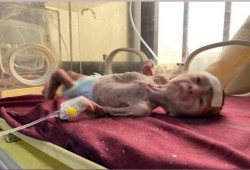 14 شهيدًا بالتجويع في غزة والحصيلة ترتفع إلى 147 منهم 88 طفلا