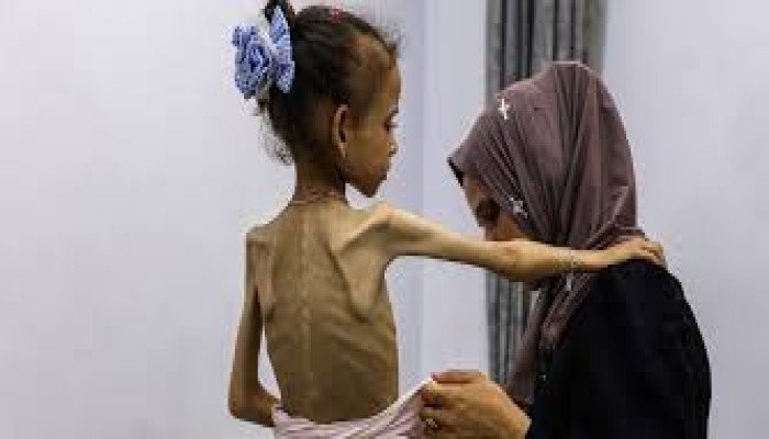 غزة تتصدر قائمة الجوع العالمي وسط حرب إبادة وحصار خانق