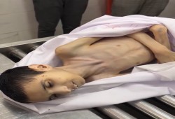 3 حالات شهادة جوعا في غزة خلال 24ساعة