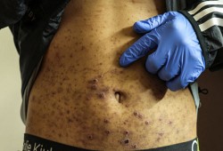 الاحتلال ينشر الجرب بين الأسرى الفلسطينيين ويمنع العلاج والطعام