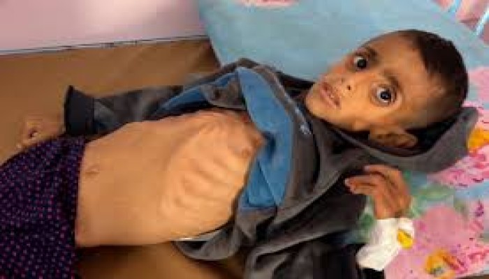 5 شهداء جوعا في غزة خلال 24 ساعة