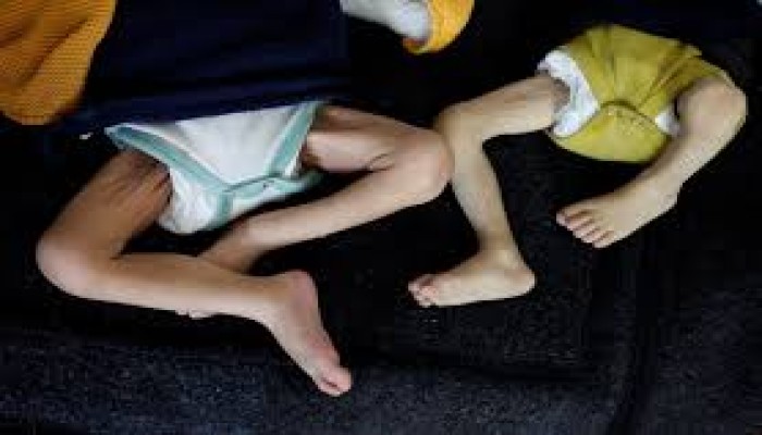 استشهاد 3 أطفال جوعا جنوبي قطاع غزة