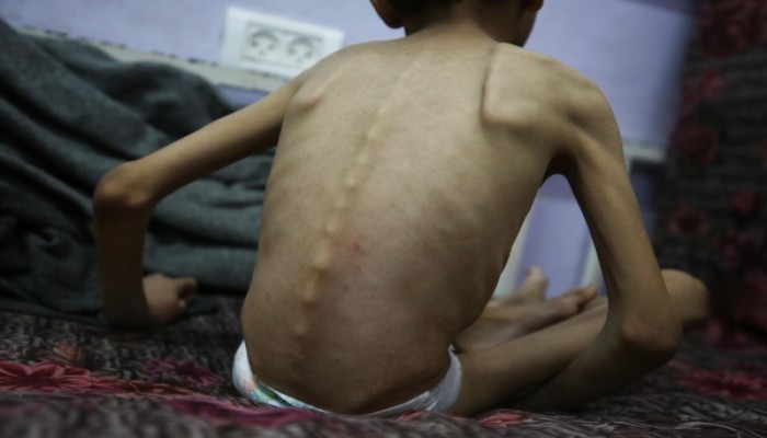 استشهاد حالة جوعا بغزة.. والحصيلة تصل 460 مواطنا