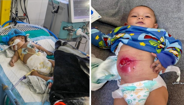 إغلاق معابر غزة يضع الأطفال المرضى على حافة الموت