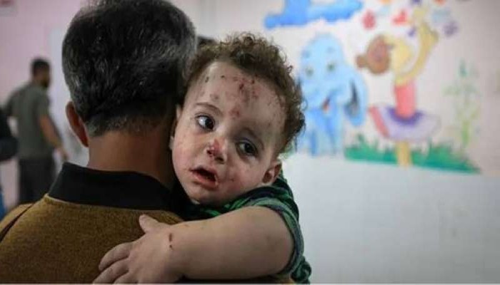 الجدري ينهش أجساد الأطفال في غزة.. الأزمة الصحية تتفاقم